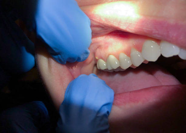 Best Emergency Broken Tooth Repair in Hill N Dale, FL